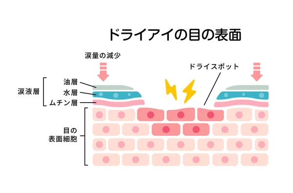 Cross Section Dry Eye Surface Flat Vector Illustration Japanese — Stock Vector