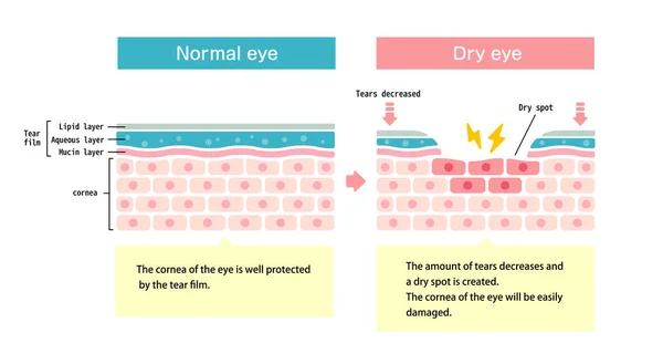 Ilustración Comparativa Entre Ojo Normal Ojo Seco Sección Transversal Superficie — Vector de stock