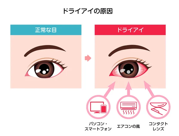 Causas Ilustração Vetor Olho Seco Japonês — Vetor de Stock