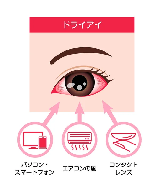 Ursachen Der Vektorillustration Für Trockenes Auge Japanisch — Stockvektor