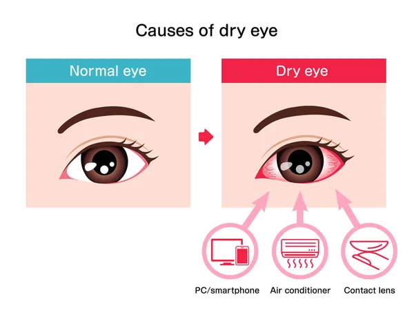 Causes Dry Eye Vector Illustration — Stock Vector