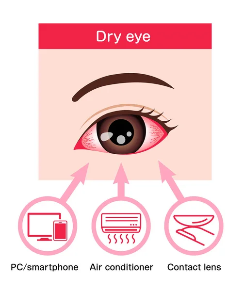 Causes Dry Eye Vector Illustration — Stock Vector