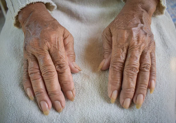 Mano Anciana Enferma Descansa Sobre Regazo Atención Salud Mental Hogar —  Fotos de Stock