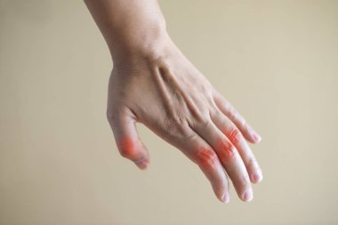 close up hand rheumatoid arthritis pateint.medical concept. clipart