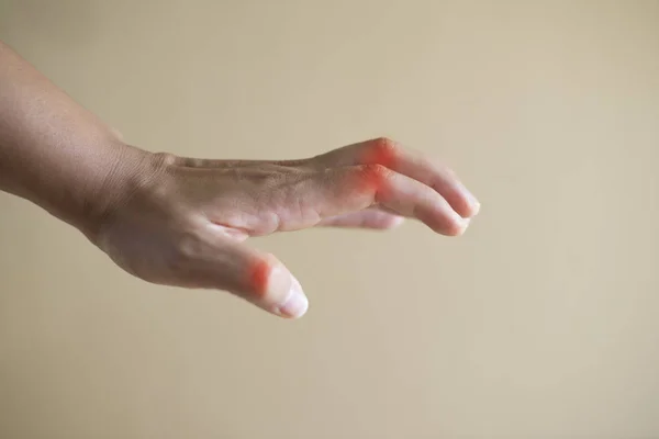 Koncepcja Pateint Medical Reumatoidalnego Zapalenia Stawów Ręki Bliska — Zdjęcie stockowe