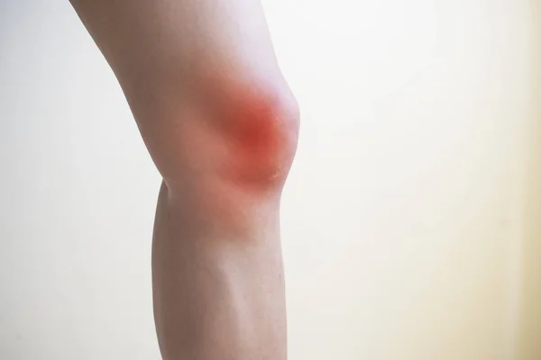 闭合膝关节炎医学科学概念 — 图库照片