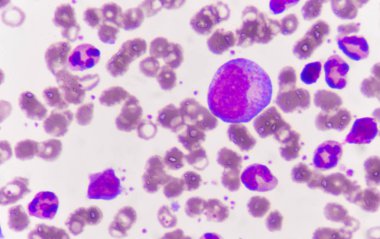 Immature blood cells in leukemia. clipart