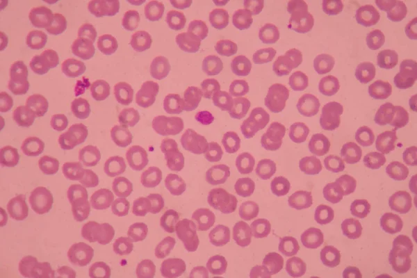 大型血小板血液塗抹赤血球背景 — ストック写真