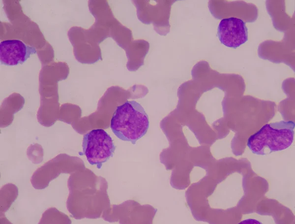 Frotis Sangre Muestran Glóbulos Blancos Inmaduros Leucemia — Foto de Stock
