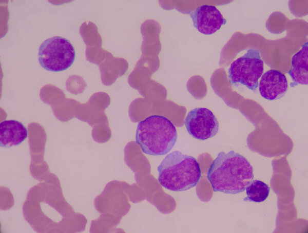 Blood smear show immature white blood cells.Leukemia