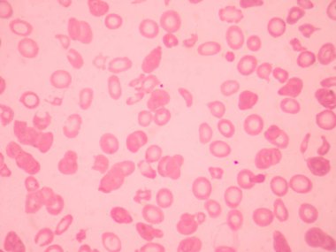 Talasemi kan smear anormal kırmızı kan hücreleri morfolojisi. Tıbbi bilim kavramı.