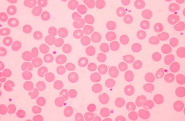 Normochromní Nomocytic Červených Krvinek Lékařská Věda Koncept — Stock fotografie
