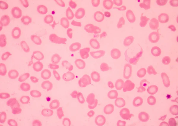 地中海贫血血涂片异常红细胞形态 医学科学概念 — 图库照片