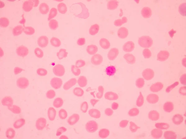 地中海贫血血涂片异常红细胞形态 医学科学概念 — 图库照片