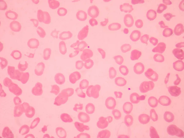 Talassemia Esfregaço Sangue Morfologia Anormal Dos Glóbulos Vermelhos Conceito Ciência — Fotografia de Stock