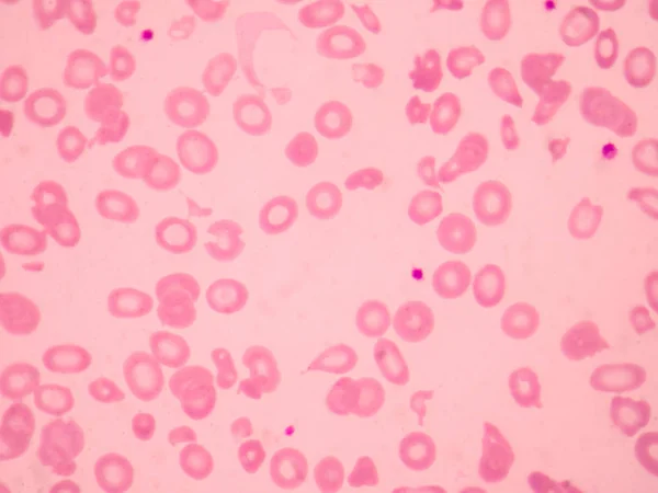Talassemia Esfregaço Sangue Morfologia Anormal Dos Glóbulos Vermelhos Conceito Ciência — Fotografia de Stock