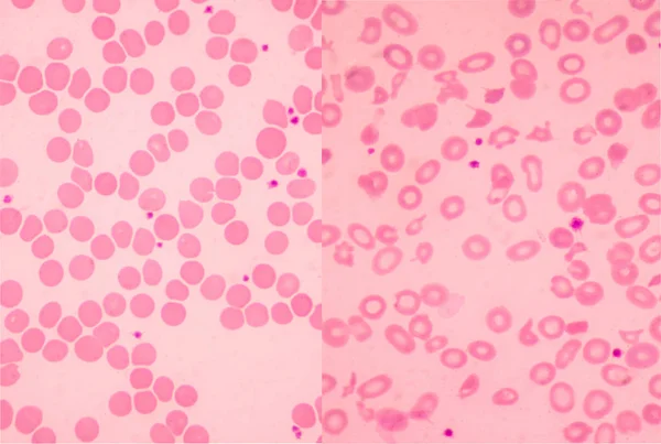 Esquerda Normal Direita Talassemia Sangue Esfregaço Conceito Ciência Médica — Fotografia de Stock