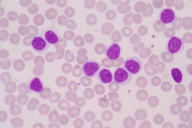 Kan hücreleri kanser kemik iliği anormal myeloblasts akyuvar türü yapar.