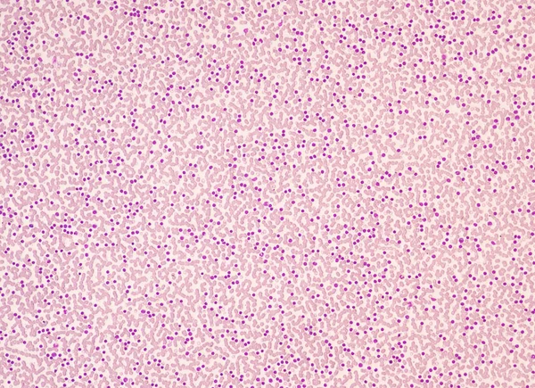 Cancro Das Células Sanguíneas Que Medula Óssea Produz Mieloblastos Anormais — Fotografia de Stock