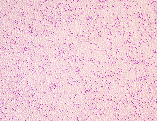 Kan Smeartof Akut Myeloid Leukemia Medical Kavramı — Stok fotoğraf