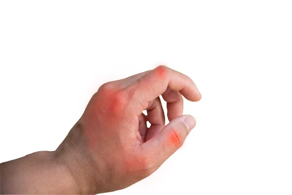 Închideți artrita mâinii pe fundal alb . — Fotografie, imagine de stoc