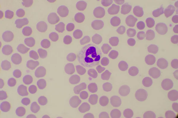 Neutrofilo in patina di sepsi trovare con microscopio . — Foto Stock