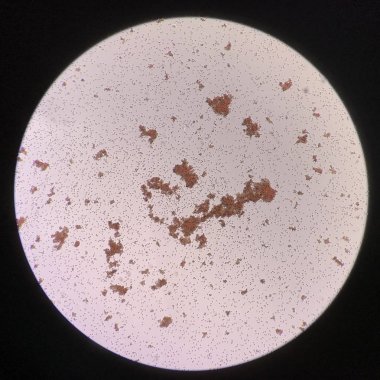 Uyumsuz çapraz eşleştirme testinde kırmızı kan hücreleri aglütinasyonu