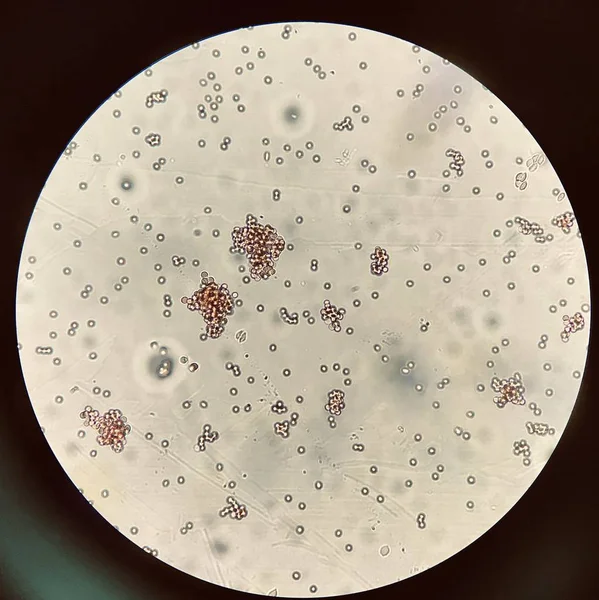 Uyumsuz çapraz eşleştirme testinde kırmızı kan hücreleri aglütinasyonu