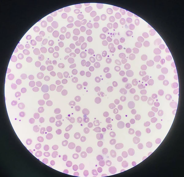 Blood smear show platelet increase. — Stock Photo, Image