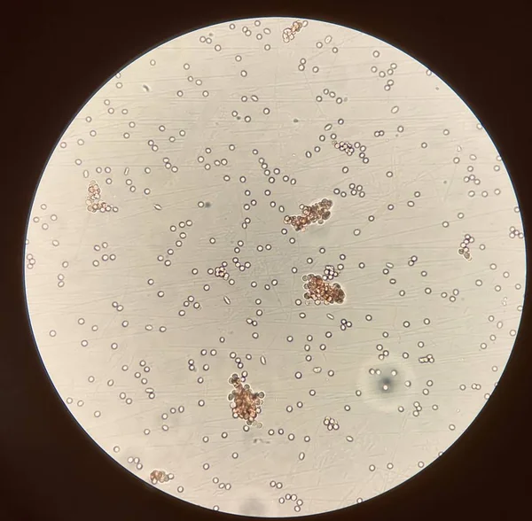 Aglutinación de glóbulos rojos en prueba cruzada incompatible — Foto de Stock