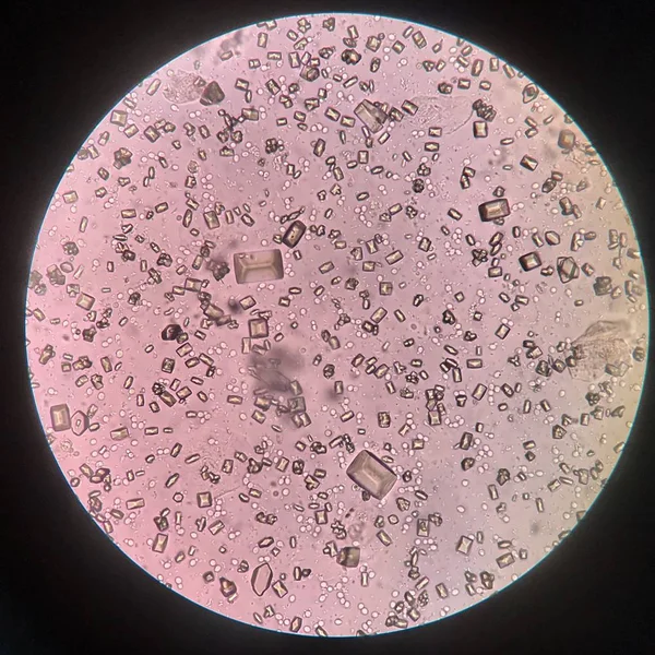 Urinanalys fynd med Mikroskop visar kristall bakterier och — Stockfoto