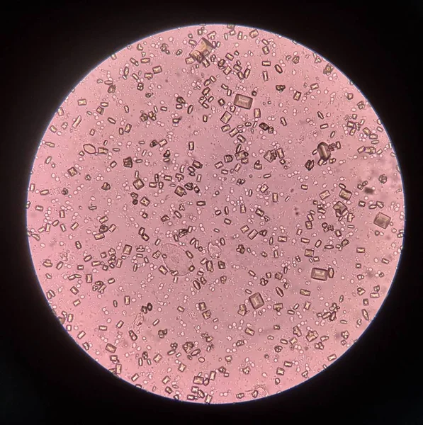 Анализ мочи с помощью микроскопа показывает кристаллические бактерии и — стоковое фото