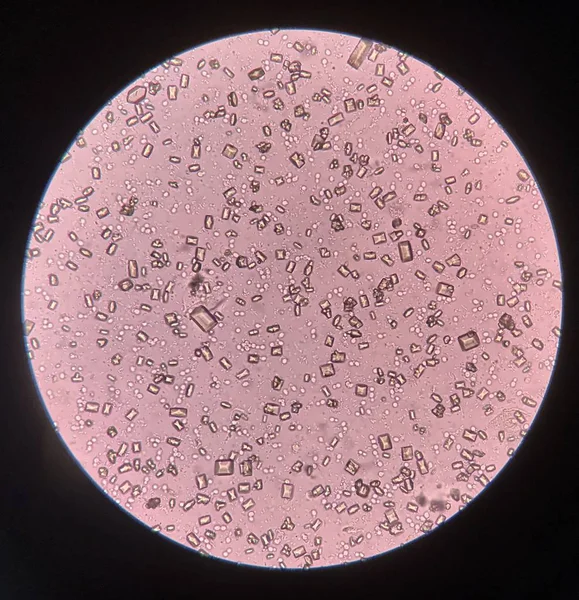 Urine analysis finding with microscope show crystal bacteria and