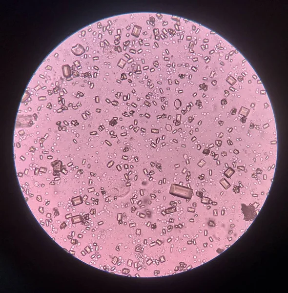 Urine analysis finding with microscope show crystal bacteria and — Stock Photo, Image