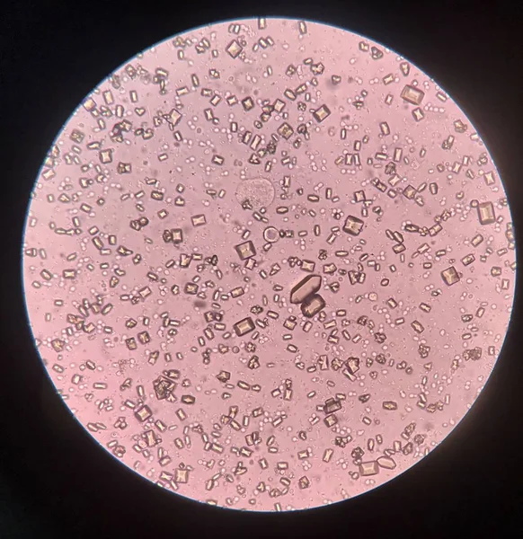 Vizelet analízis vizsgálat Mikroszkóp mutat kristály baktériumok és — Stock Fotó