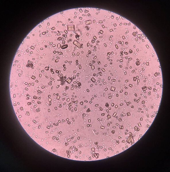Urine analysis finding with microscope show crystal bacteria and