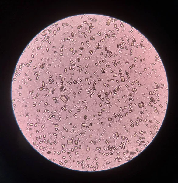 Анализ мочи с помощью микроскопа показывает кристаллические бактерии и — стоковое фото