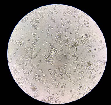 Orta bakteri ve beyaz kan hücreleri sabır bakteri idrar