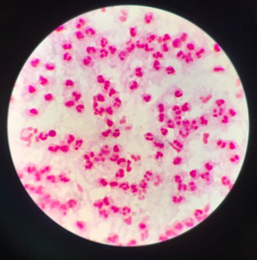 Örnek Synovail sıvısında orta derecede beyaz kan hücreleri.