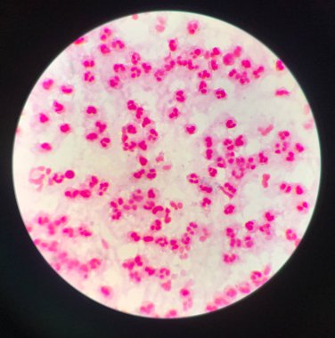 Örnek Synovail sıvısında orta derecede beyaz kan hücreleri.