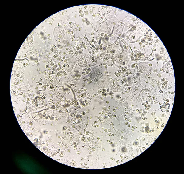 Bacterias moderadas y glóbulos blancos en las bacterias del paciente urina — Foto de Stock