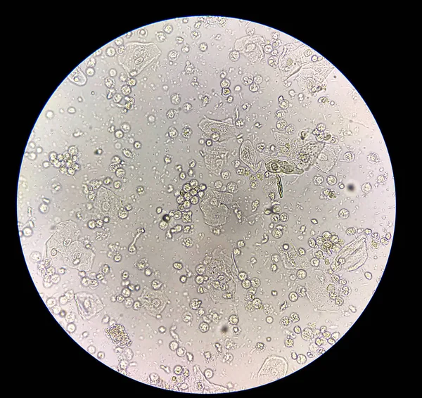 Умеренные бактерии и белые кровяные тельца в моче — стоковое фото
