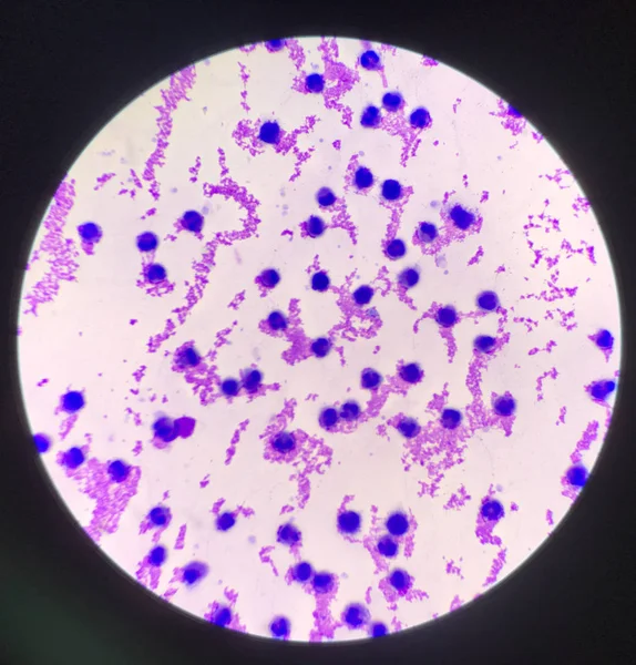 Globuli bianchi moderati nel campione Fluido sinoviale . — Foto Stock