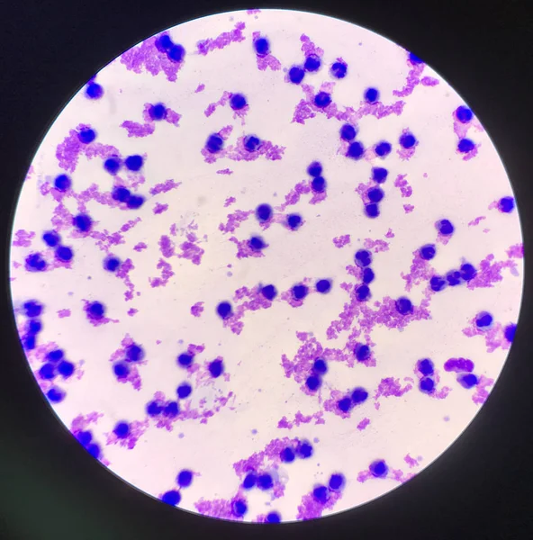 Mérsékelt fehérvérsejtek a mintában Synovail folyadék. — Stock Fotó