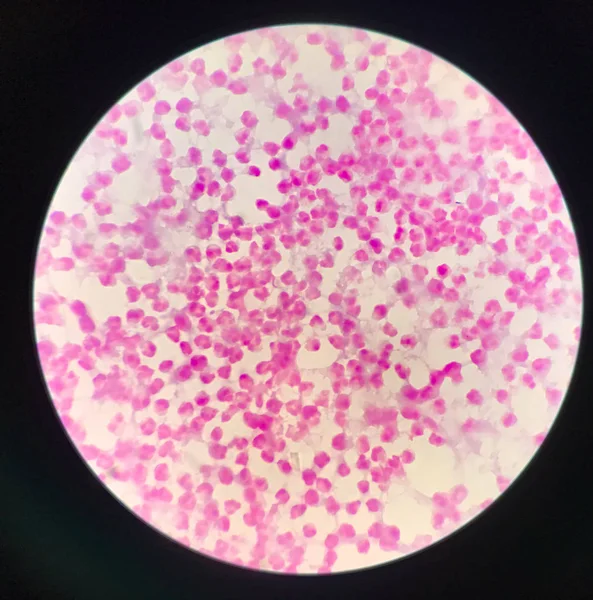 Gematigde witte bloedcellen in specimen Synovail vloeistof. — Stockfoto