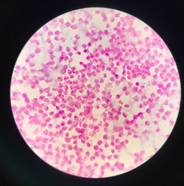 Moderate white blood cells in specimen Synovail fluid.