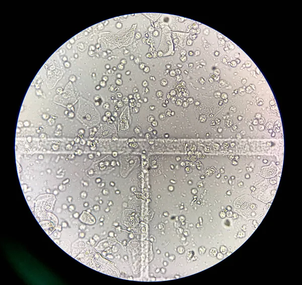 Moderate bacteria and white blood cells in patien bacteria urina — Stock Image Moderate bacteria and white blood cells in patien bacteria urina Stock Image