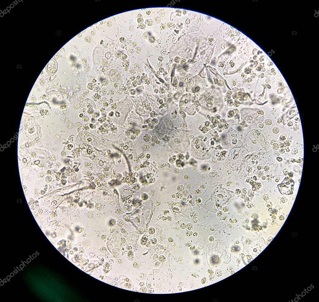 Moderate bacteria and white blood cells in patien bacteria urina