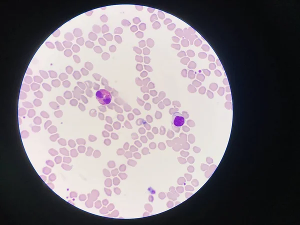 Comparação de glóbulos brancos Eosinófilos e Lytmphocyte . — Fotografia de Stock