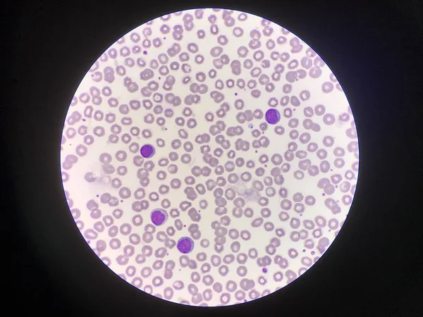 Linfócitos maduros no fundo dos glóbulos vermelhos . — Fotografia de Stock